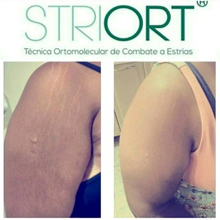 STRIORT Técnica Ortomolecular de Combate a Estrias - Antes e Depois - braço