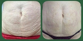 STRIORT Técnica Ortomolecular de Combate a Estrias - Antes e Depois - barriga