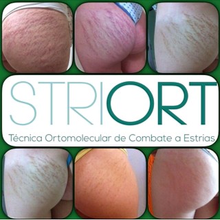 STRIORT Técnica Ortomolecular de Combate a Estrias - Antes e Depois - bumbum