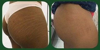 STRIORT Técnica Ortomolecular de Combate a Estrias - Antes e Depois - bumbum