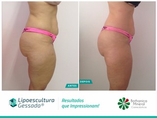 Lipoescultura Gessada - antes e depois