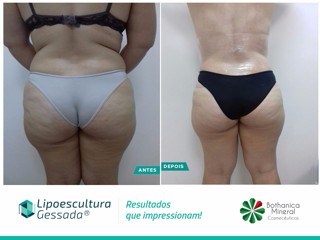 Lipoescultura Gessada - antes e depois