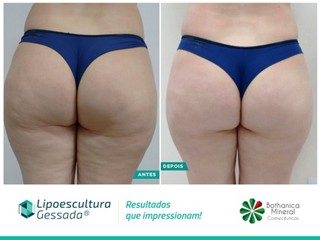 Lipoescultura Gessada - antes e depois