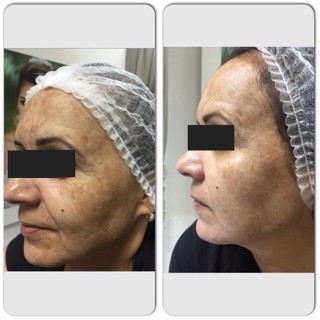 técnica Peeling 3D - Estética Itajaí - Fisioterapeuta Giliane