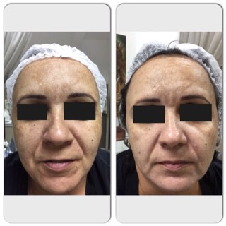 técnica Peeling 3D - Estética Itajaí - Fisioterapeuta Giliane