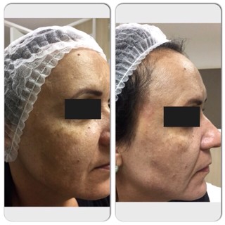 técnica Peeling 3D - Estética Itajaí - Fisioterapeuta Giliane