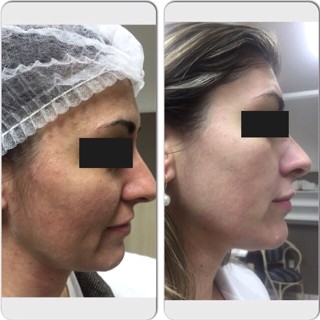 técnica Peeling 3D - Estética Itajaí - Fisioterapeuta Giliane