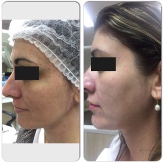 técnica Peeling 3D - Estética?????? Itajaí - Fisioterapeuta Giliane