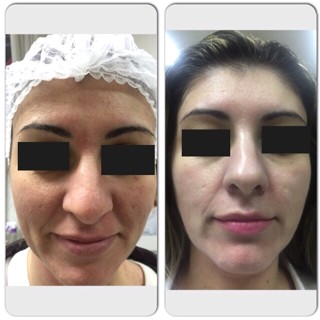 técnica Peeling 3D - Estética Itajaí - Fisioterapeuta Giliane