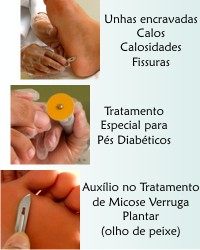 unhas encravadas - calos - calosidades - fissuras - tratamento especial pra pés diabéticos - auxílio no tratamento de micose verruga plantar - olho de peixe